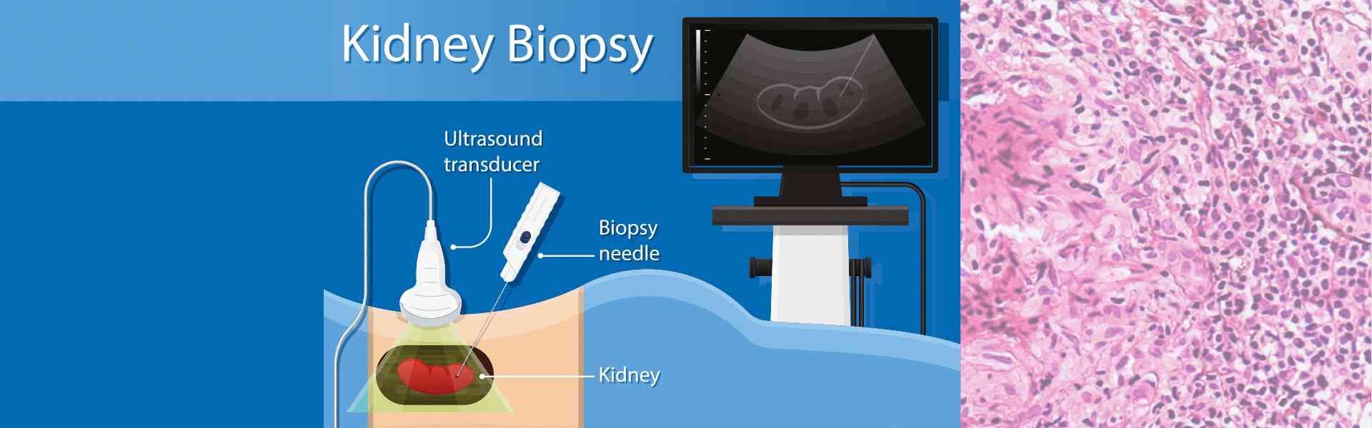 Kidney Biopsy Surgery in Dwarka 