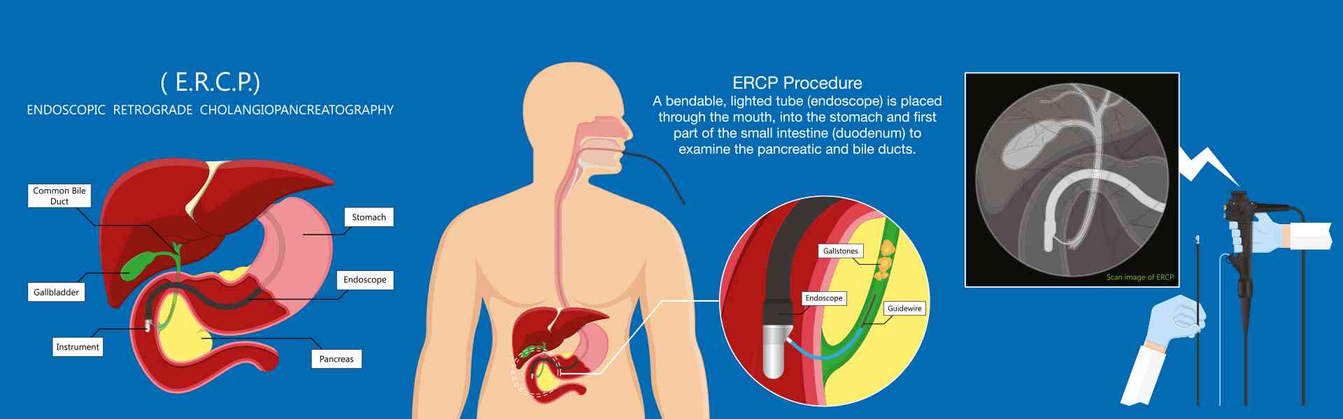 ERCP Diagnostic Test in Gurugram