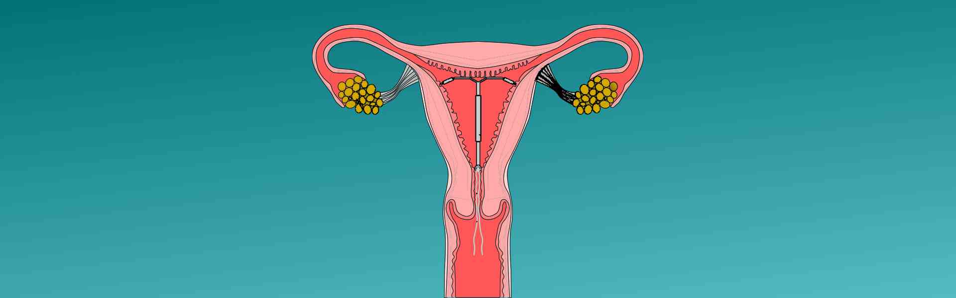 Iud Placement Centres in Kharadi