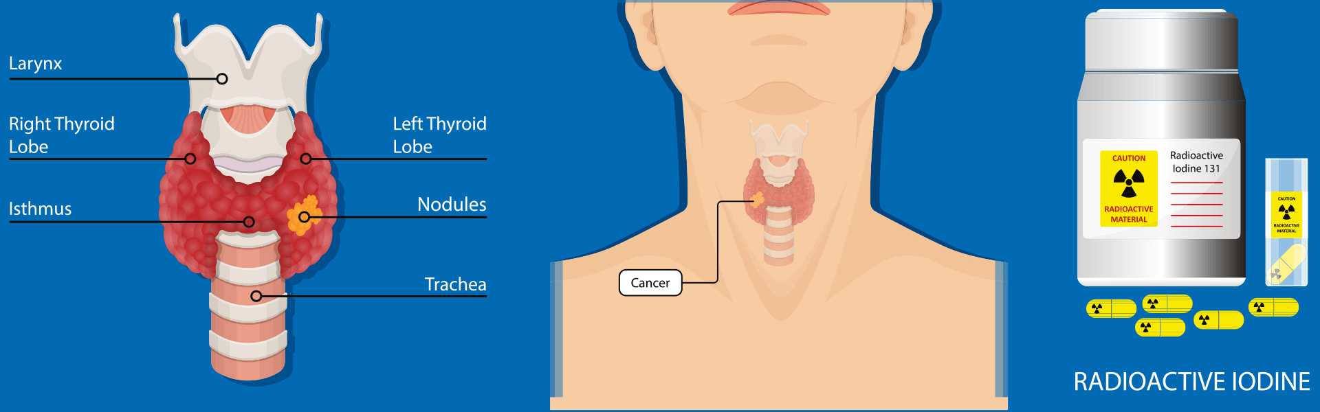 Iodine 131 Therapy For Thyroid Cancer in Bangalore