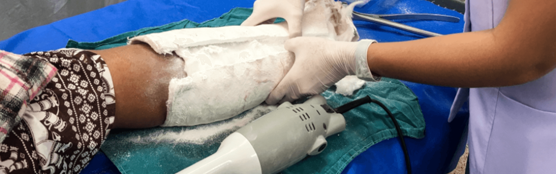 Cast Removal | Manipal Hospitals India