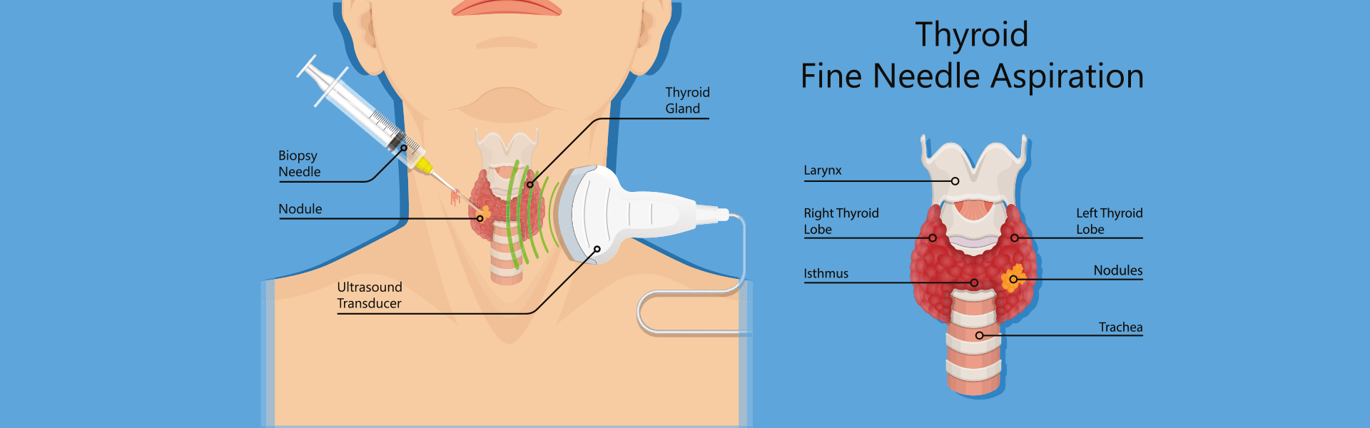 FNAC Procedure | Fine Needle Aspiration Cytology Test in India