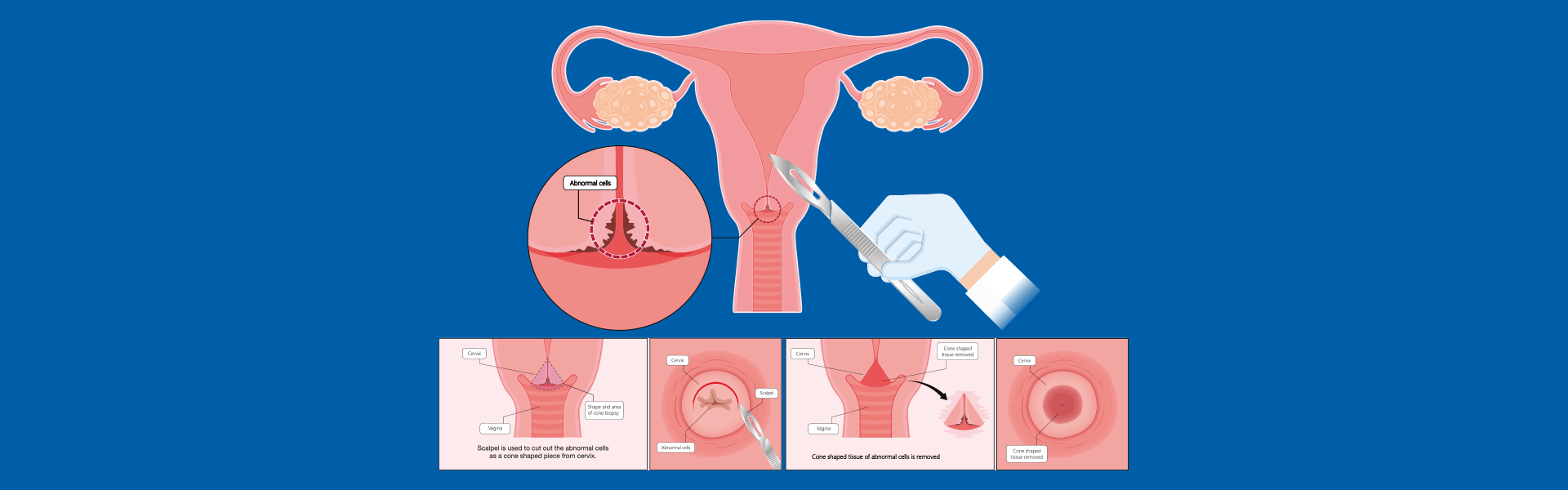 Pap Smear Test In Bangalore, India