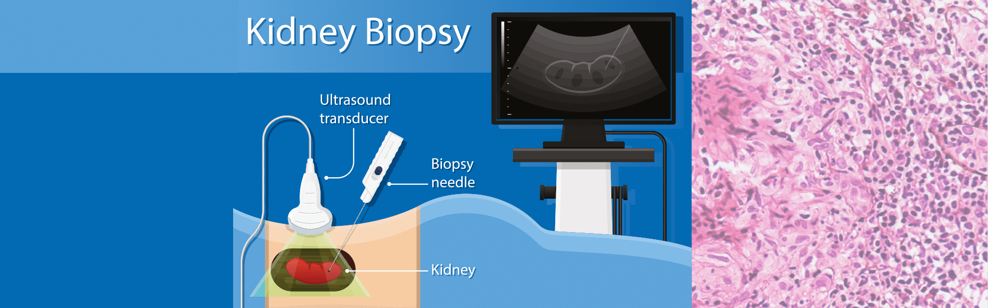 Kidney Biopsy | Manipal Hospitals India