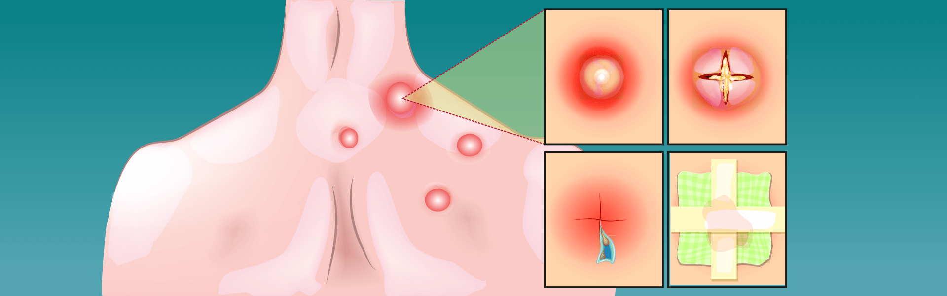 Skin Abscess | Manipal Hospitals India